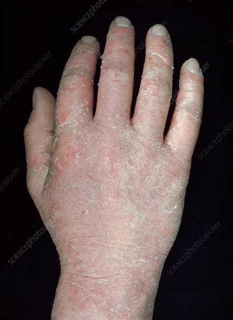 Eczema On The Hand Stock Image C0404488 Science Photo Library