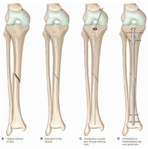 Knee And Leg Musculoskeletal Key