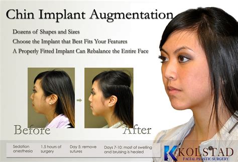 Chin Augmentation Dr Kolstad San Diego Facial Plastic Surgeon