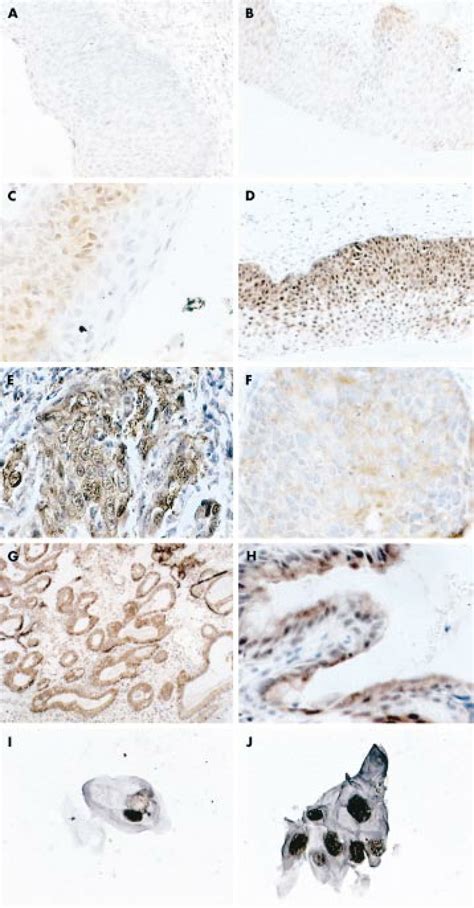 Scoring System For P16 Ink4a Immunostaining In Cin3 Lesions A