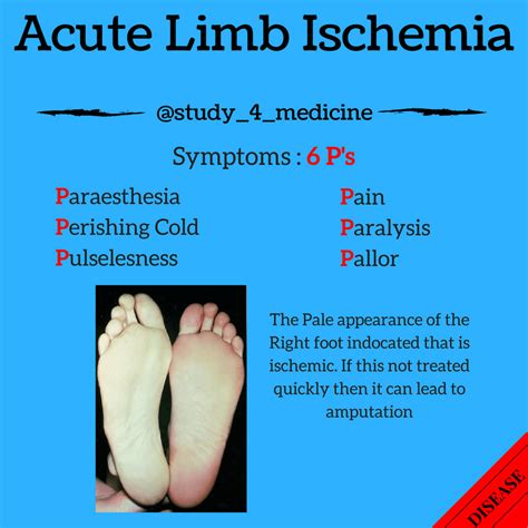 Acute Limb Ischemia 6 Ps Clinical Manifestations Of Acute Limb