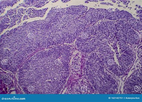 Bladder Transitional Cell Carcinoma Light Micrograph Stock Image