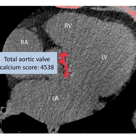 Figure Non Enhanced Ct Of Severe Aortic Valve Calcification Total