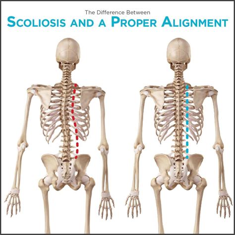Understanding Adult Scoliosis Causes Symptoms And Treatment Options
