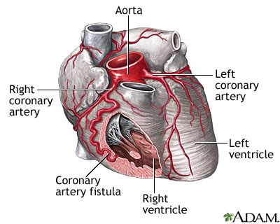 Coronary artery disease accounts for > 30% of death in west and presents acutely as acute coronary syndromes. Coronary artery fistula | UF Health, University of Florida ...