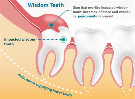 Wisdom Teeth Hobart Orofacial Pain And Special Needs Clinic