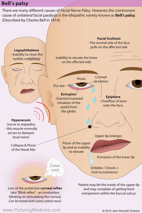 Facial Nerve Palsy Symptoms