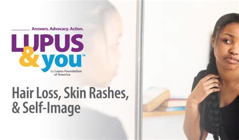 Lupus And You Answers Advocacy Action Lupus Foundation Of America