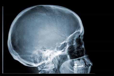 The auditory ossicles (malleus, incus, and stapes) of each ear are also bones in the head separate from the skull. Skull Fractures | Andy Citrin Injury Attorneys