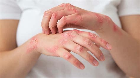 Skin Diseases Types Symptoms Diagnosis Treatment And Diet
