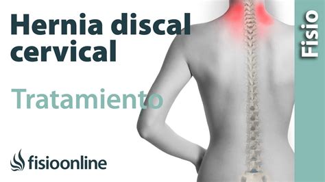 Hernia Discal Cervical Tratamiento Con Ejercicios Automasajes Y Estiramientos YouTube