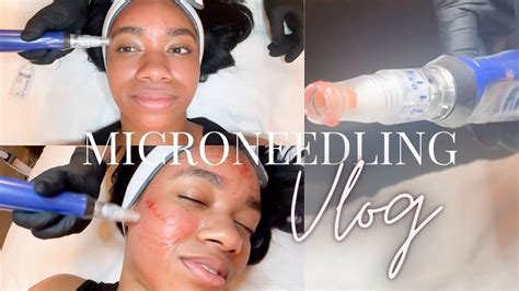 Microneedling Before During And After Beautiful Encounters Youtube
