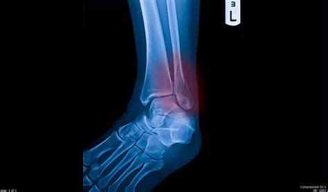 Lateral Malleolus Fracture Anatomy Diagnosis And Treatment Data Max
