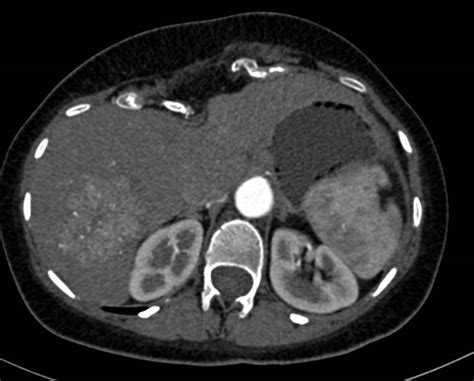 Focal Nodular Hyperplasia Liver Case Studies Ctisus Ct Scanning