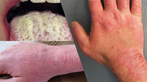 Causes And Treatment Of Discolored Skin Patches Health Gadgetsng