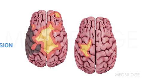 Neuroimaging And Stimulation For Rehab Part 2 Clinical Application