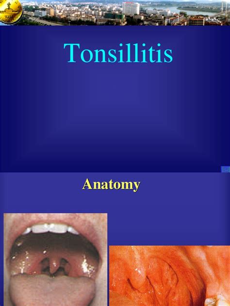 Tonsillitis Jpk Gxmu Edu Cn Epidemiology Public Health