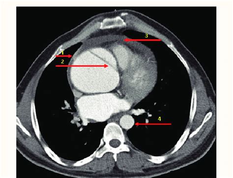 Axial Computed Tomography Ct Image Through Ascending Aa And