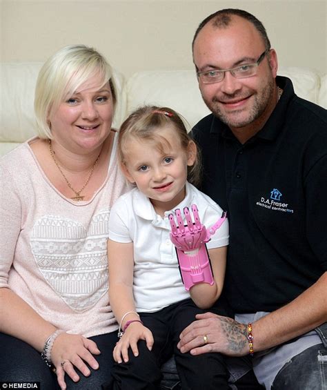 Basically, a pair of gloves with their fingers cut off at varying lengths. Hayley Fraser born without fingers is first to receive ...