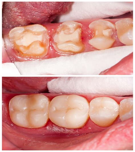 Dental Inlays And Onlays Siam Station Dental Clinic