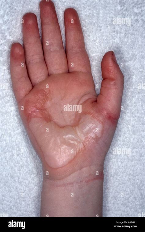 2nd Degree Burn Wound Healing 4 Year Old Child Stock Photo Alamy