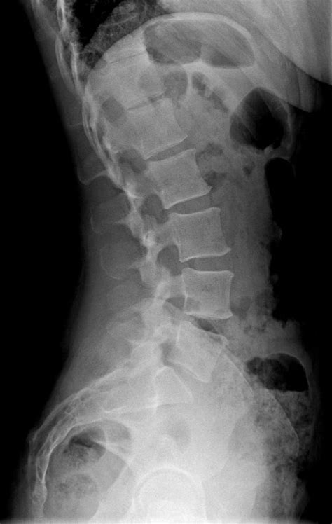The presence of a lumbosacral transitional vertebra alters normal spine biomechanics. ¿Qué es la hiperlordosis lumbar? - Curiosoando