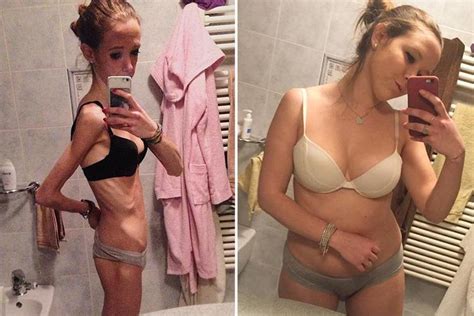 Anorexic Teen Whose Weight Dropped To Five Stone After Splitting From