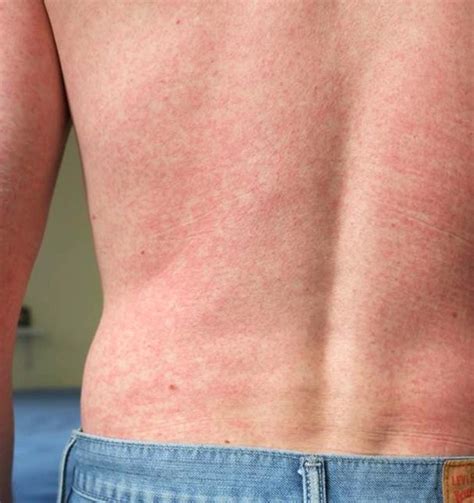 Zika Cutaneous Signs And Symptoms Mdedge Dermatology