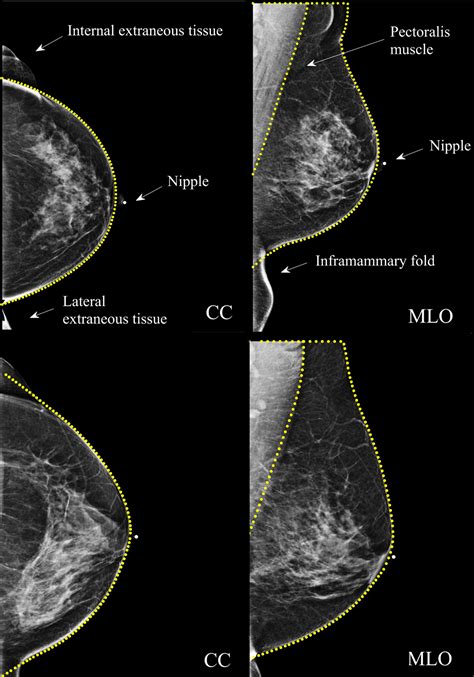 Pdf Mammography Positioning Standards In The Digital Era 56 Off