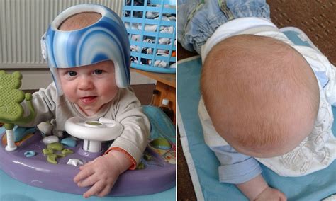 Parents Spend £2000 On Special Helmet To Cure Their Baby Of Flat Head