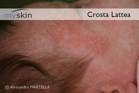 Crosta lattea del neonato : sintomi e trattamento | Myskin ...