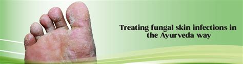 Treating Fungal Skin Infections In The Ayurveda Way