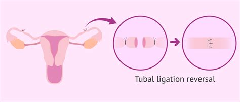 Bilateral Tubal Ligation
