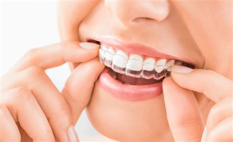 What Exactly Does The Invisalign Aligner Do For Your Teeth