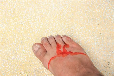 Foot Wound Becomes Infected With Apply Medication Select Focus With