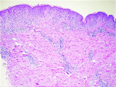 Perivascular And Interstitial Infiltration Composed Of Neutrophils