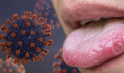 Covid Update Covid Tongue And Ulcers Should Be Added To Symptoms List Says Researcher Express