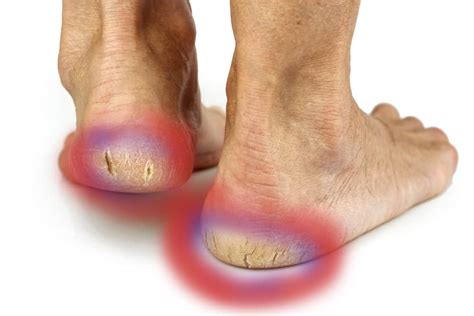 Skin Conditions Foot Treatment In Launceston Cornwall Podiatrist