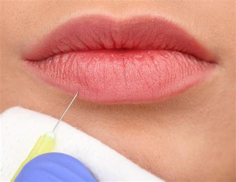 How Long Do Collagen Injections Last With Pictures