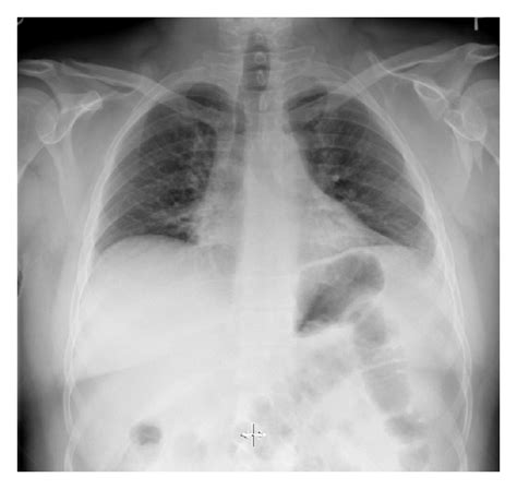 Anteroposterior Chest Radiograph Demonstrating A Left Scapular Fracture