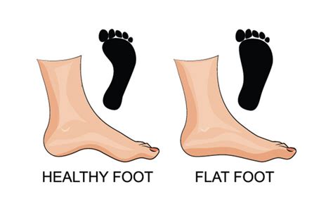 The Truth About Flat Feet In Children—what Parents Need To Know