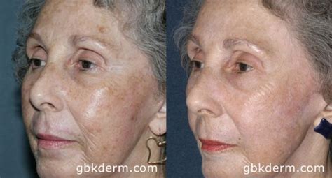 Age Spots Age Spots On Face Best Skin Cream Skin Care Remedies
