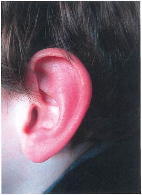 Primary Red Ear Syndrome Associated With Cochleo Vestibular
