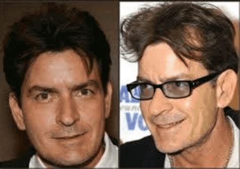 Male Celebrities With Hair Loss Baldness Before After Photos