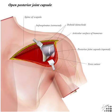 Posterior To Shoulder Approaches Orthobullets