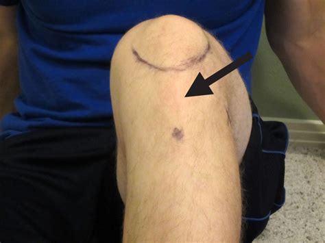 How To Self Treat Patellar Tendon Pain With A Mobility Band The