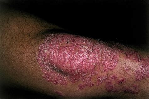 Acd A Z Of Skin Psoriasis