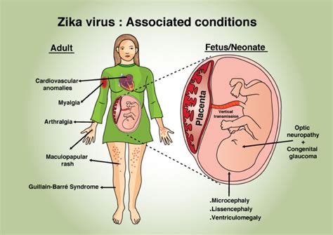 Zika Virus Symptome Ursachen Und Behandlung MedDe