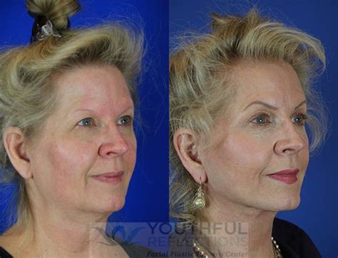 facelift reflection lift before and after photos patient 35 nashville tn youthful reflections