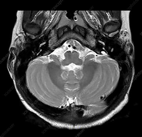 Large Vestibular Aqueduct Hearing Loss Mri Stock Image C0306468